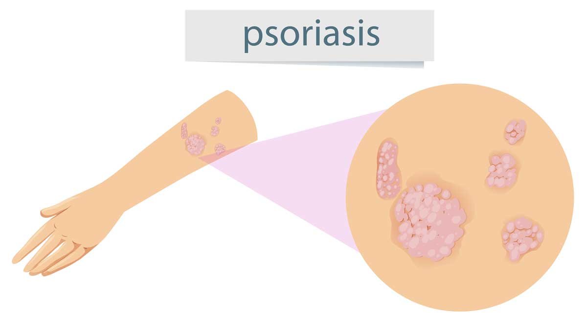 Psoriasis - Symptoms, Causes, Types, Diagnosis, Treatment, and Prevention