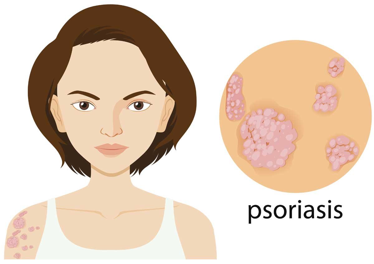 Ayurvedic Solutions for Psoriasis Treatment